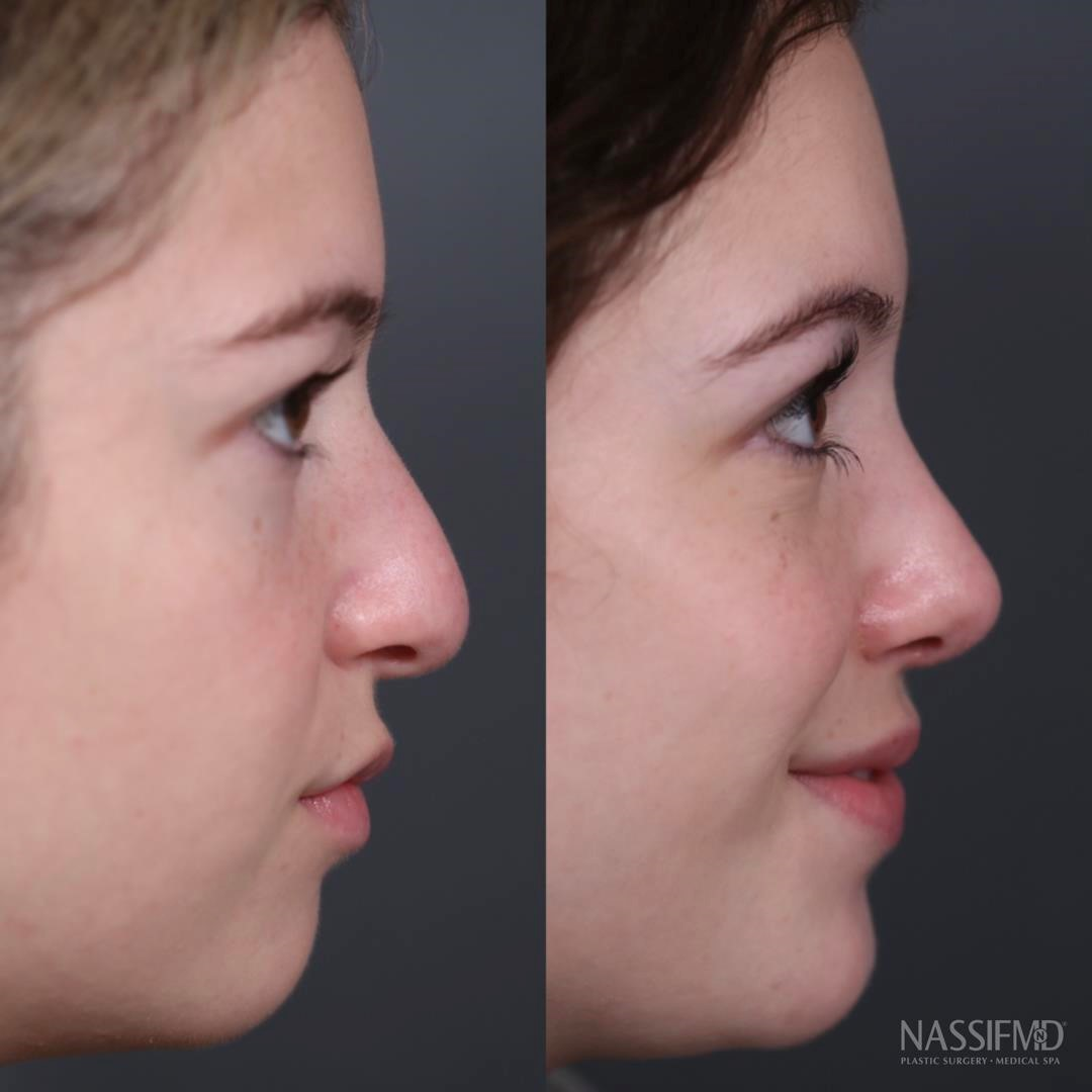 rhinoplasty surgery