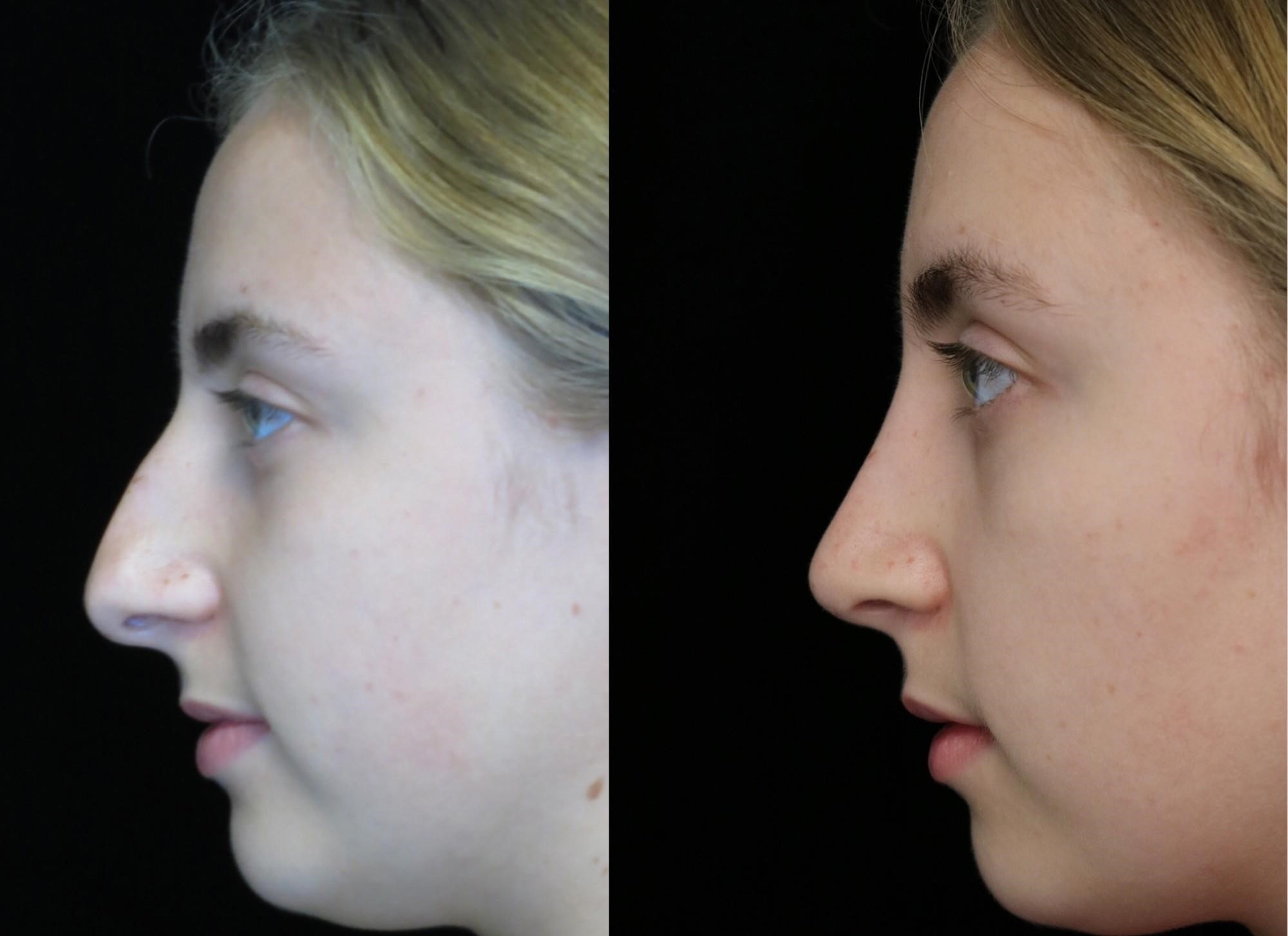 rhinoplasty surgery