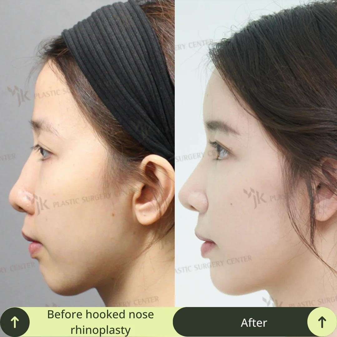 rhinoplasty surgeons near me