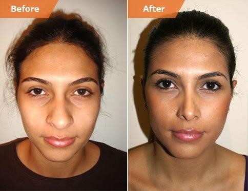 rhinoplasty surgery