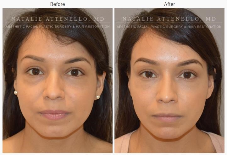 rhinoplasty surgeons near me